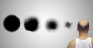 male pattern baldness