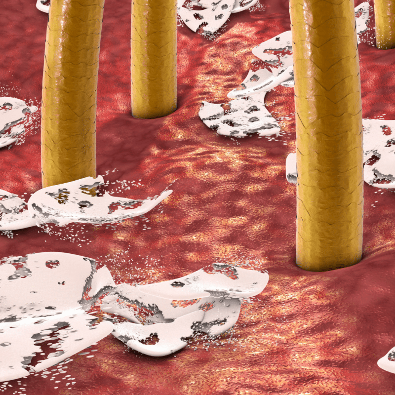 dandruff causes and prevention