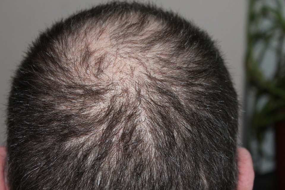 hair loss and growth melatonin