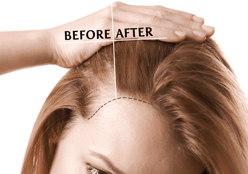 Female Pattern Hair Loss