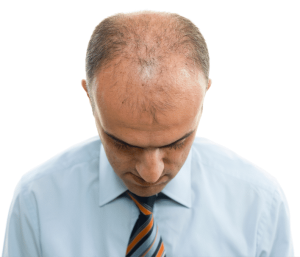 Androgenetic Alopecia