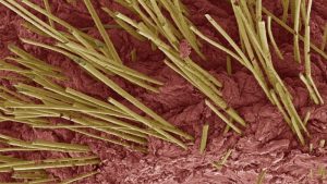 hair shaft abnormalities