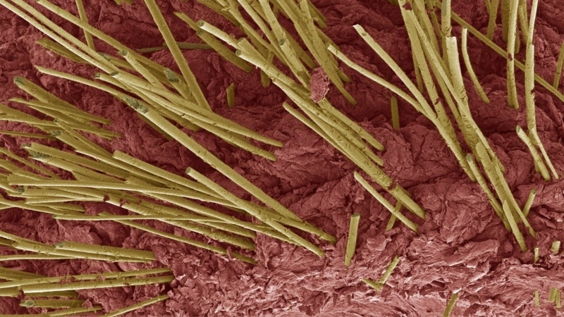 hair shaft abnormalities