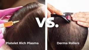 Microneedling VS Platelet-Rich Plasma