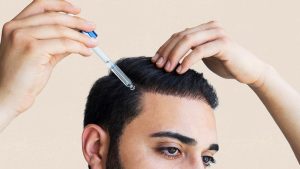 Androgenetic Alopecia Treatment Options