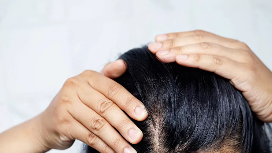 Diffuse Alopecia Areata